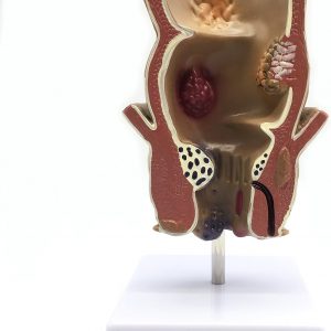 Medical Human haemorrhoids Model Anatomy for Science Classroom Study Display and Patient Education Teaching Medical Model
