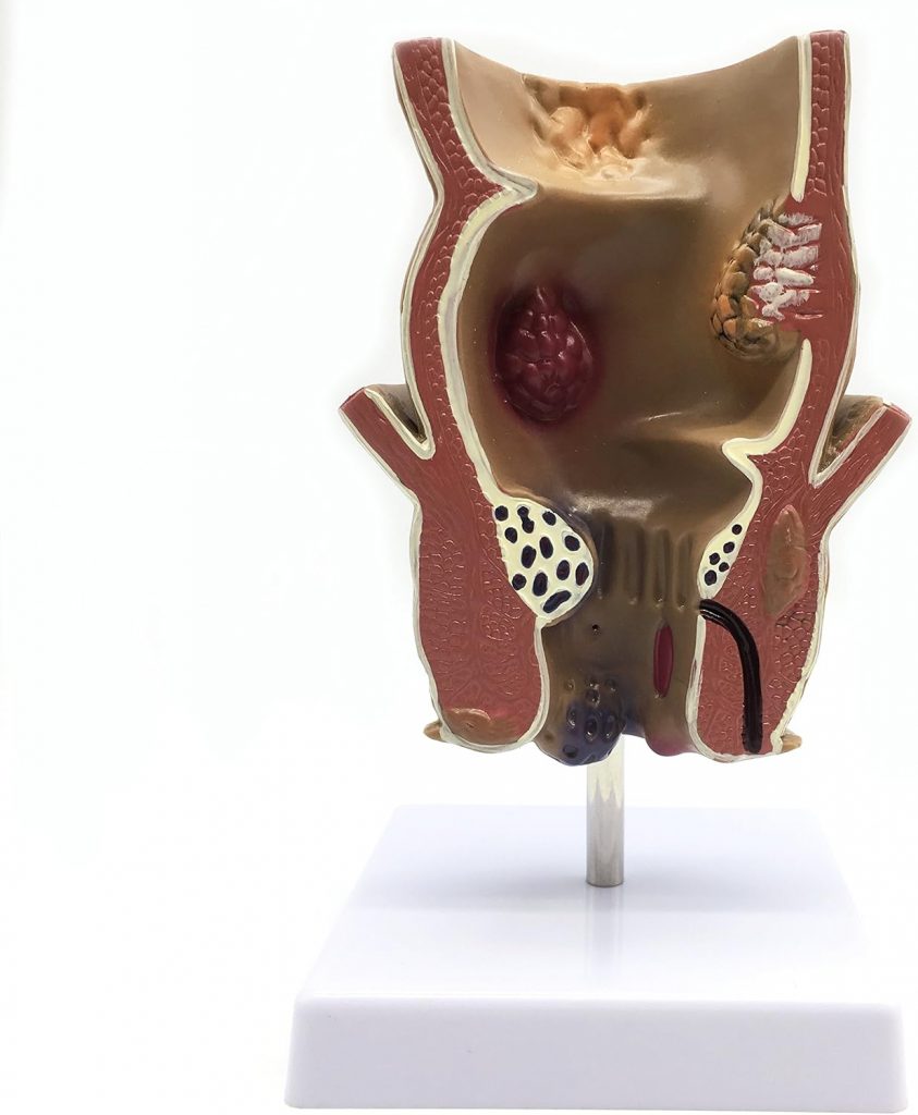 Medical Human haemorrhoids Model Anatomy for Science Classroom Study Display and Patient Education Teaching Medical Model